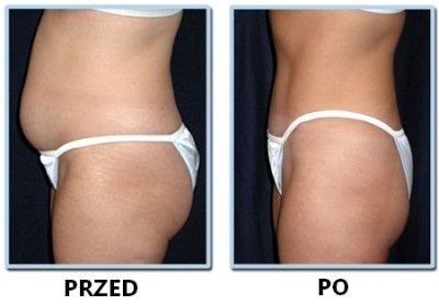 Liposukcja ultradźwiękowa